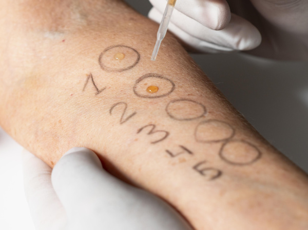 Allergologie Prik-Test